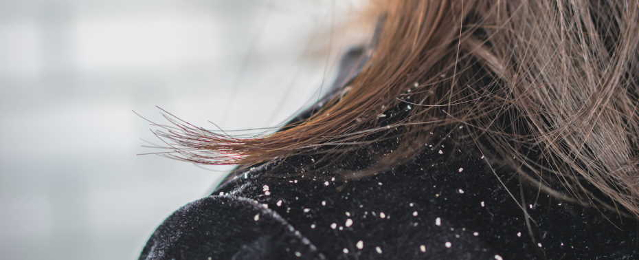 treat dandruff in hair