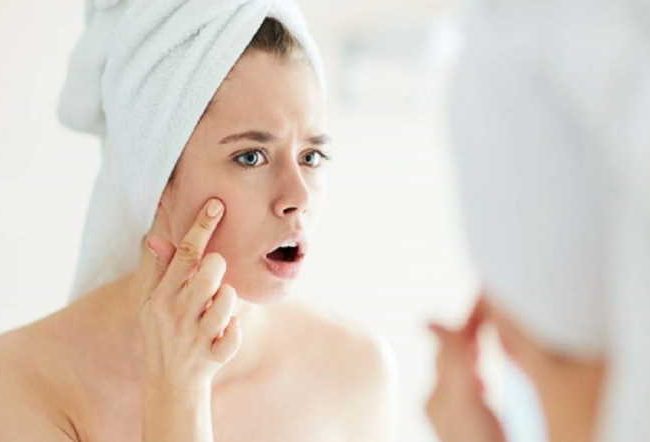 How Can You Make Acne Disappear In Two Days?